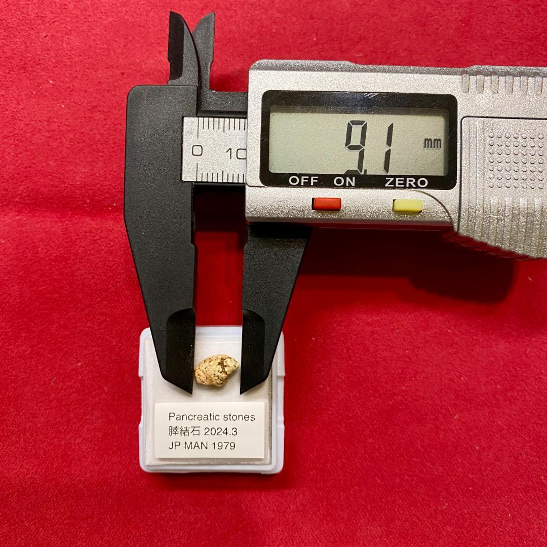 【超希少石】膵結石　超希少な膵結石　膵石　スイセキ　人体石標本資料