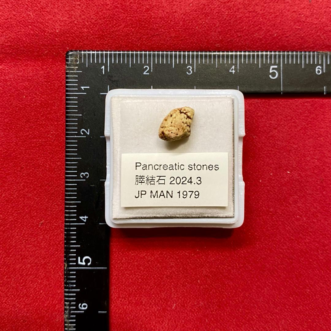 【超希少石】膵結石　超希少な膵結石　膵石　スイセキ　人体石標本資料