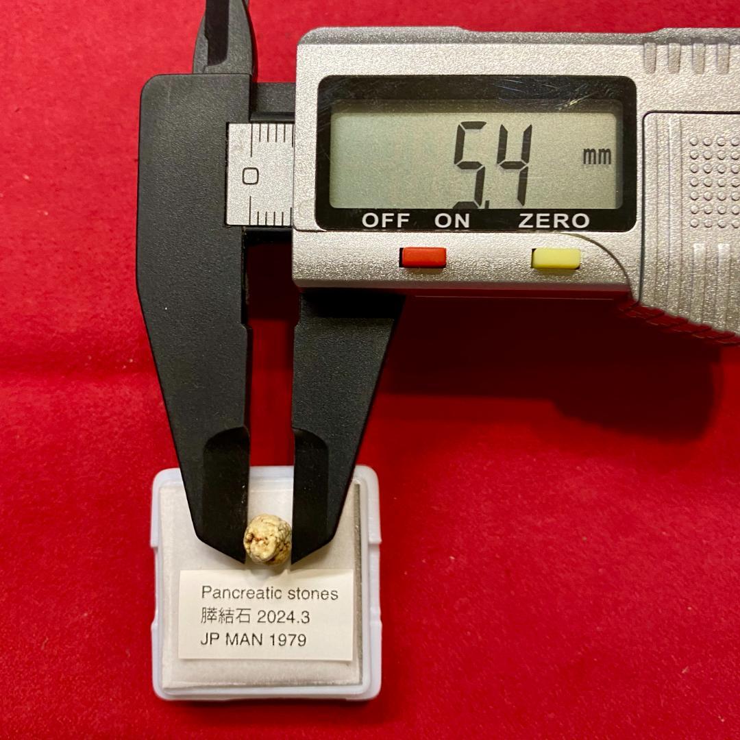 【超希少石】膵結石　超希少な膵結石　膵石　スイセキ　人体石標本資料