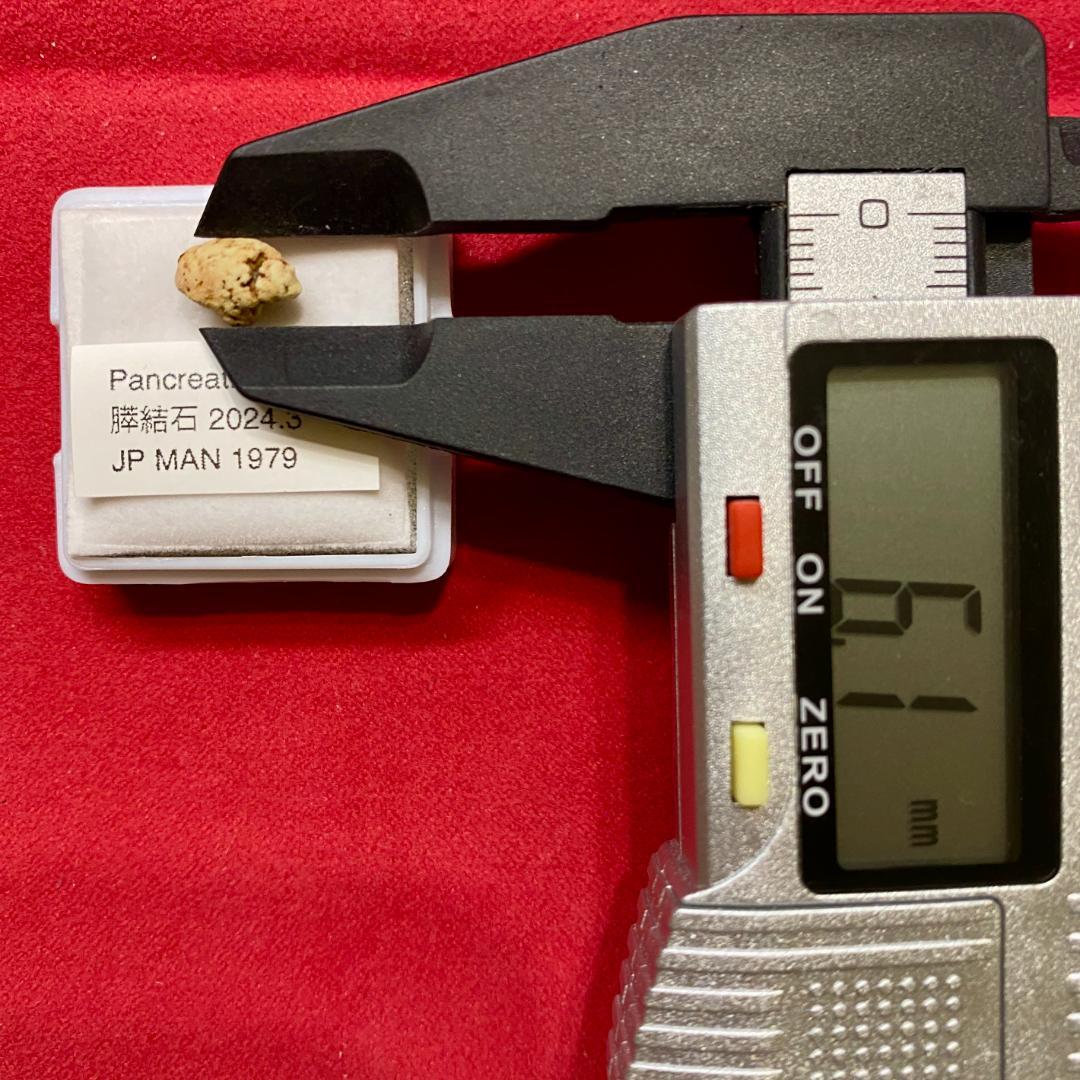 【超希少石】膵結石　超希少な膵結石　膵石　スイセキ　人体石標本資料