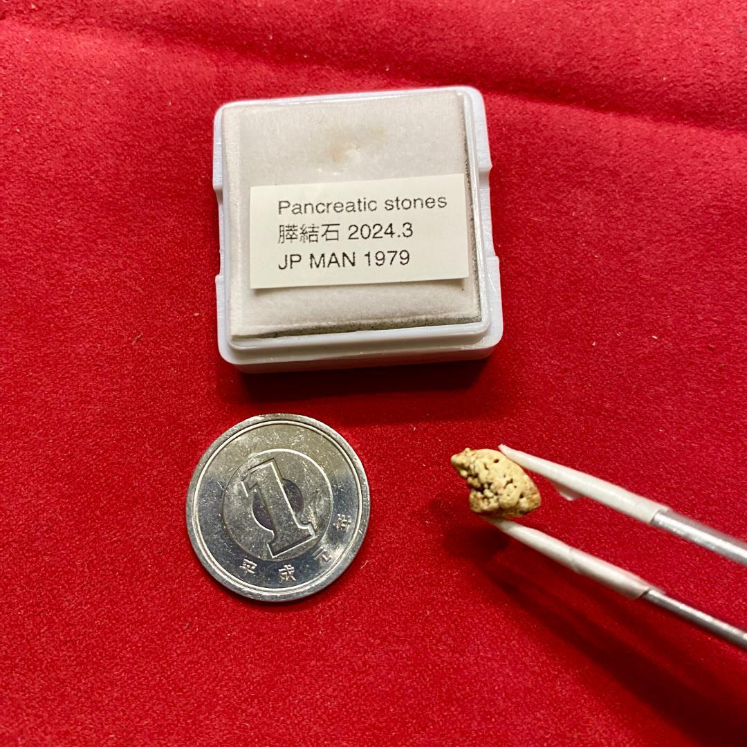 【超希少石】膵結石　超希少な膵結石　膵石　スイセキ　人体石標本資料