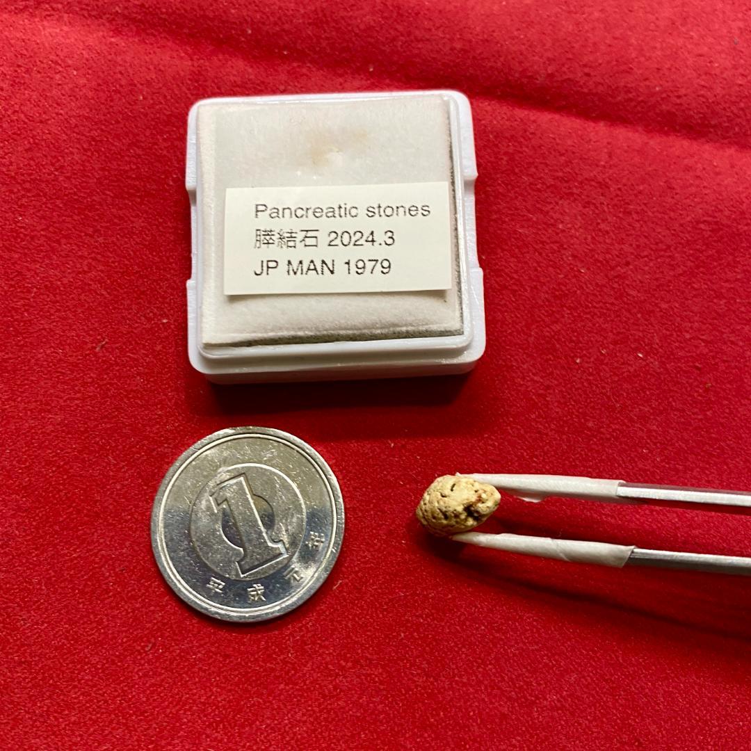 【超希少石】膵結石　超希少な膵結石　膵石　スイセキ　人体石標本資料