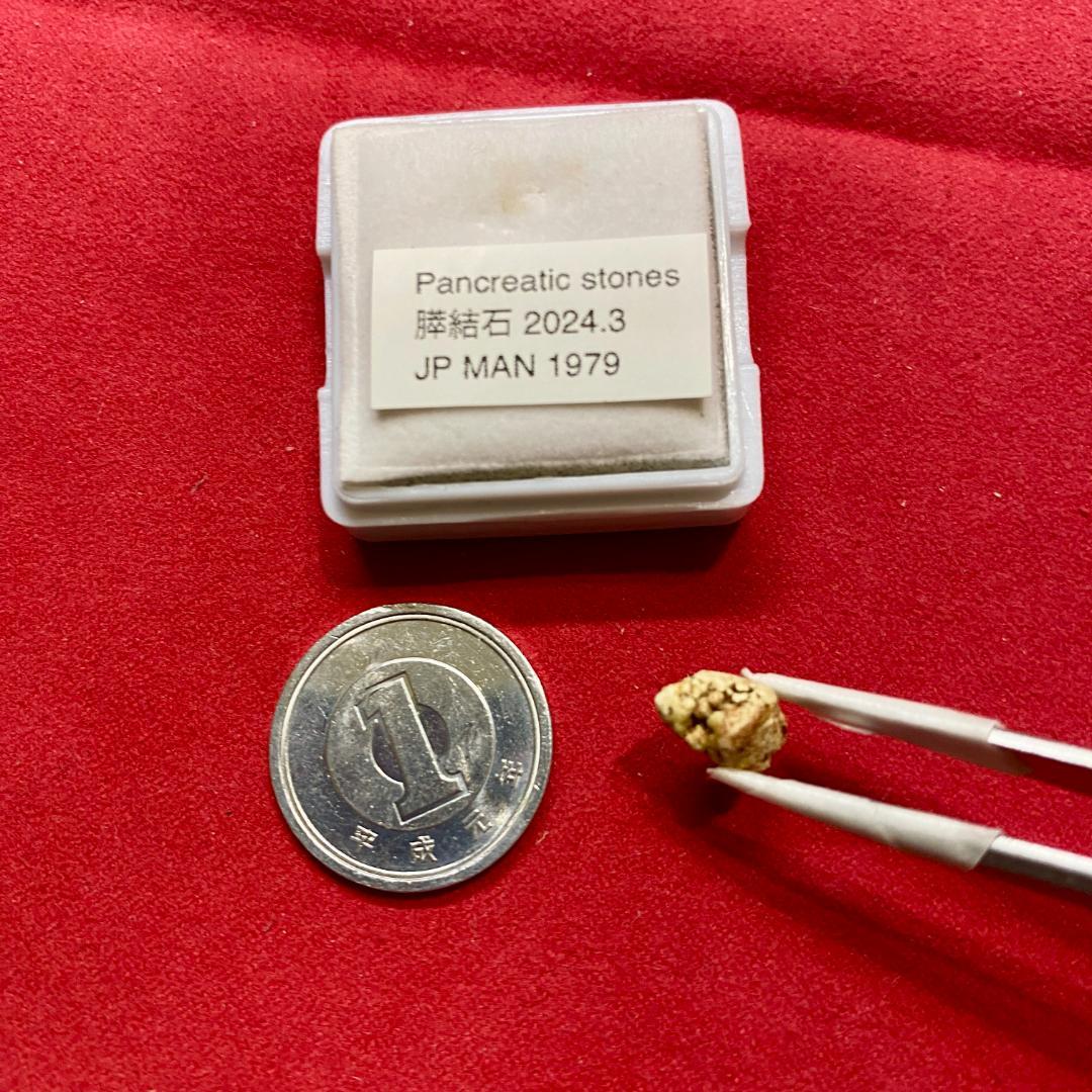 【超希少石】膵結石　超希少な膵結石　膵石　スイセキ　人体石標本資料