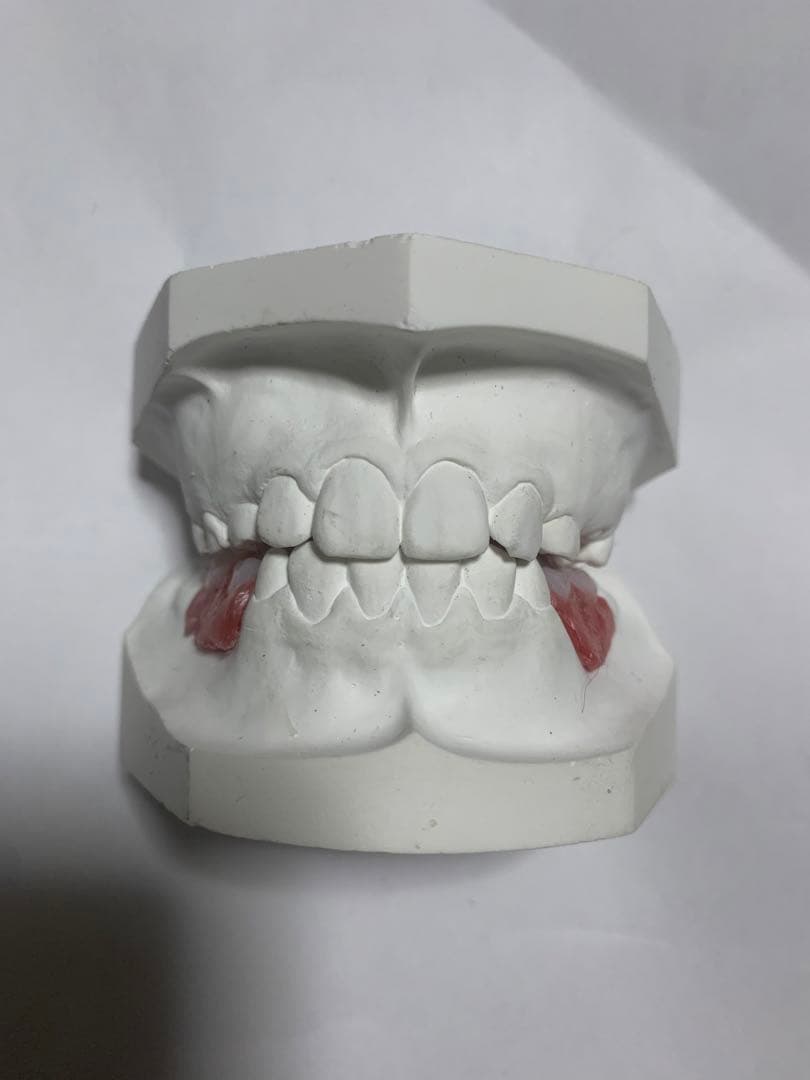小児　入れ歯　顎模型