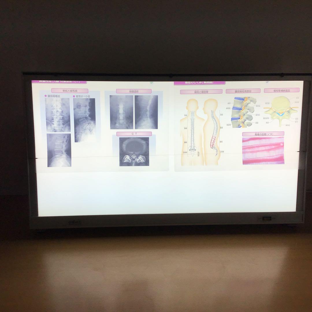 シャウカステン（シャーカステン）＋脊柱管説明フィルムセット