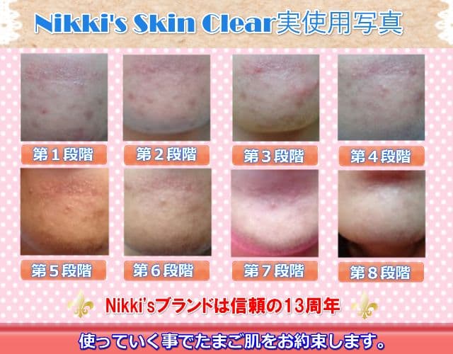ニキビ跡、毛穴、しみ、そばかす　噂のNikki's Skin Clear 通常版
