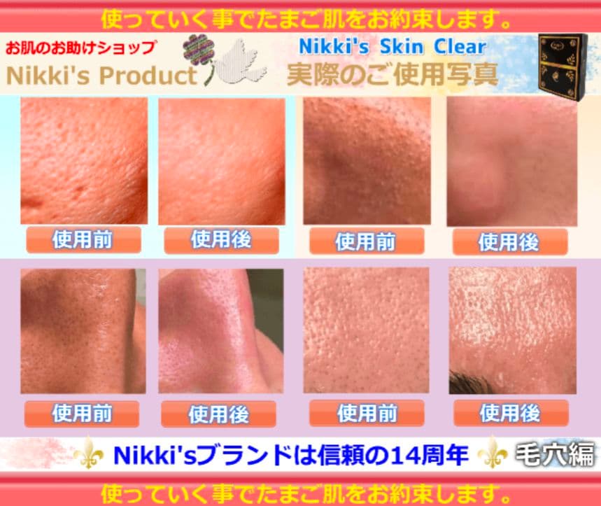 ニキビ跡、毛穴、しみ、そばかす　噂のNikki's Skin Clear 通常版