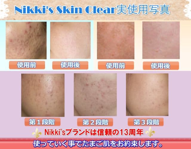 ニキビ跡、毛穴、しみ、そばかす　噂のNikki's Skin Clear 通常版