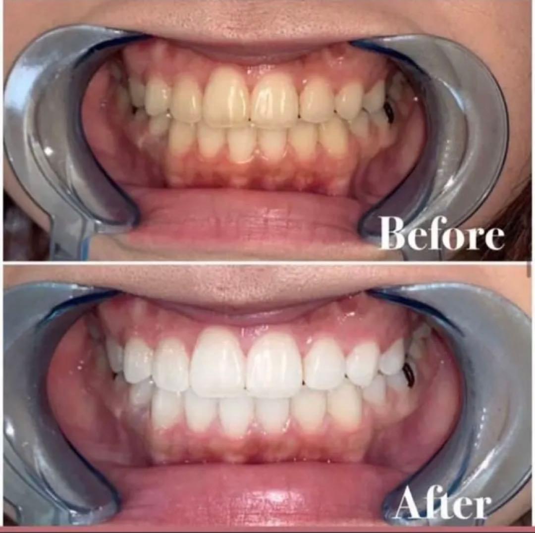 ホワイトニング溶剤【酸化タングステン配合】