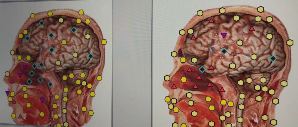 期間限定セール☆波動測定器18D NLS メタトロン ニュースキャン