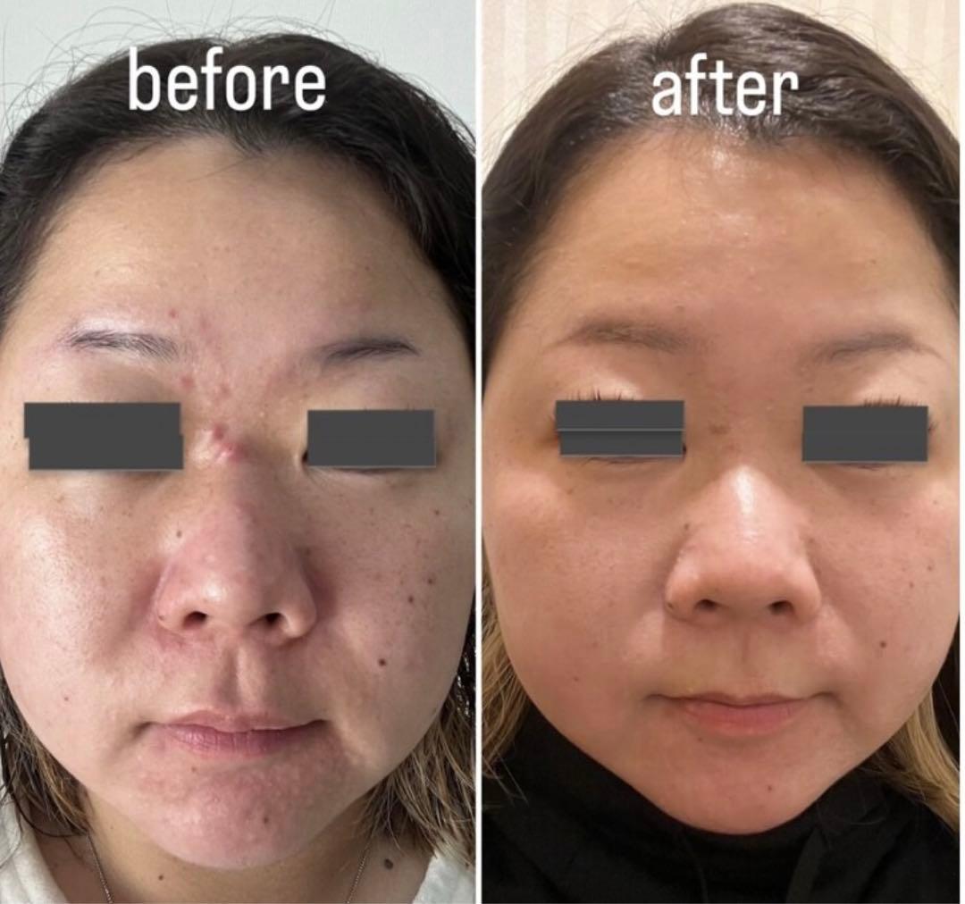 ハーブピーリング 剥離あり 皮剥けあり 8-9回分→9g - メルカリ